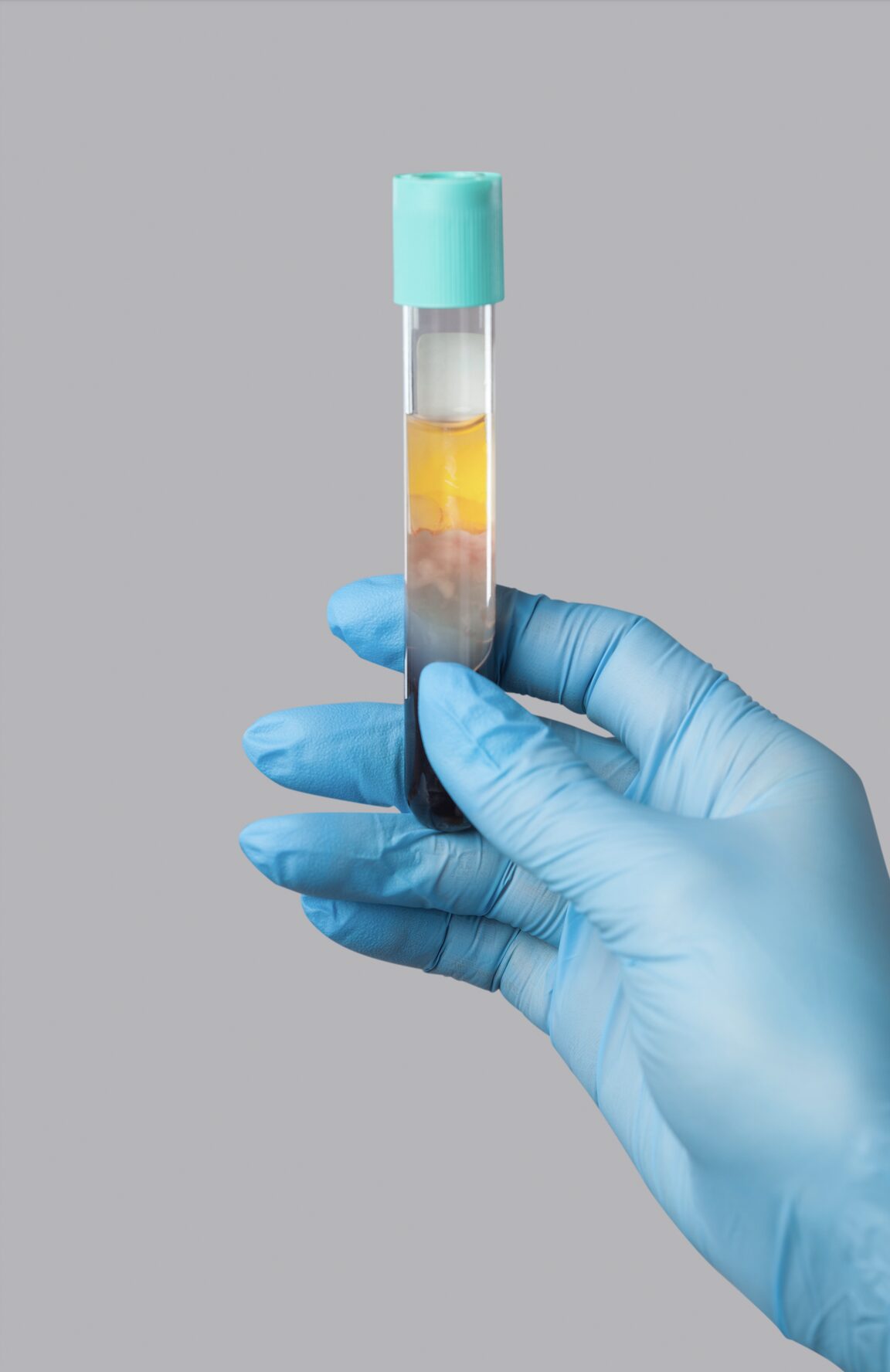 PRP Treatment 1 - RejuviLux Wellness, PLLC a hand holding a test tube with a liquid in it