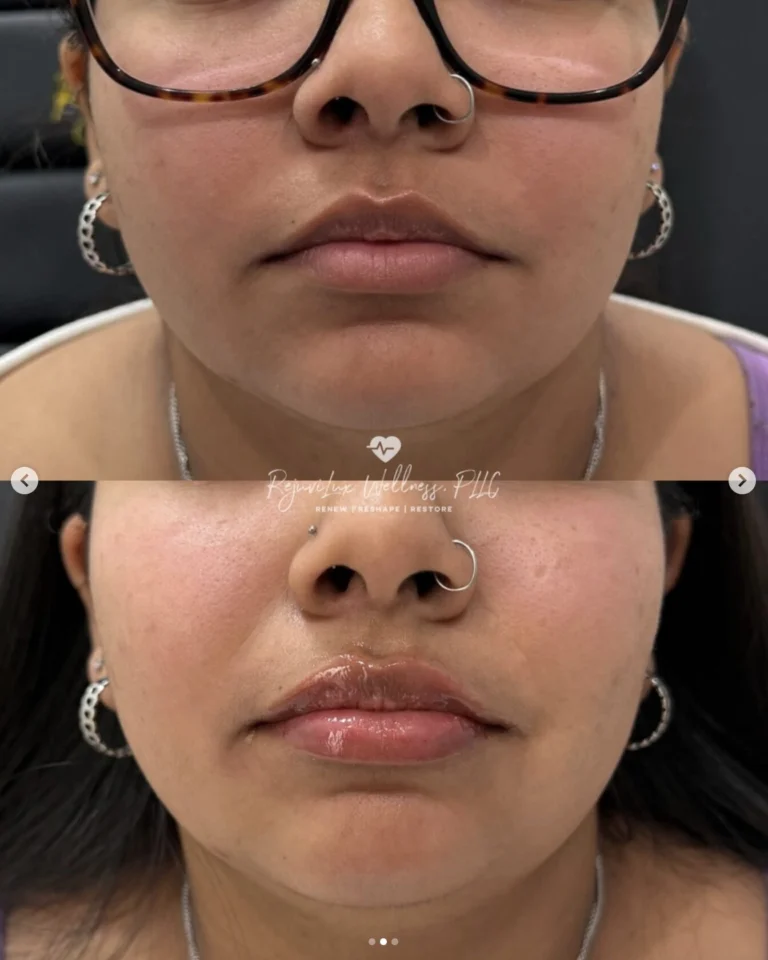 Lip Filler Before and After