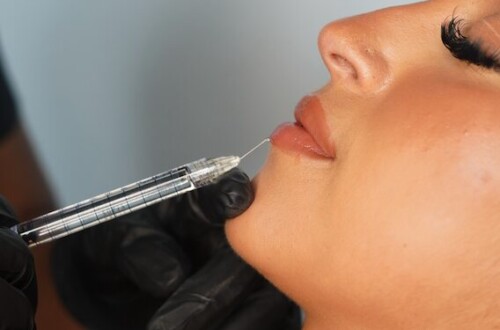 Dermal Filler Treatment