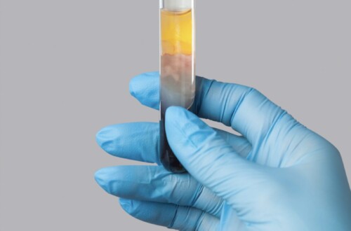 Platelet-Rich Plasma (PRP)