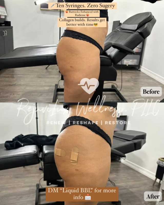 ✨ Subtle. Sculpted. Naturally You. ✨

Our beautiful patient wanted natural-looking volume and lift in the buttocks,  and we delivered just that with a non-surgical Radiesse enhancement💉🍑

We used 10 syringes of Radiesse, a unique biostimulatory filler that not only adds instant volume, but also stimulates your body’s own collagen production over time for long-lasting, natural results.

🔍 What is Radiesse?
Radiesse is a calcium-based dermal filler that works in two powerful phases:
1️⃣ Immediate volume and contour using a smooth gel matrix.
2️⃣ Long-term tissue improvement as your body builds collagen around the filler over the next 6–12 weeks.

⏳ When will I see results?
You’ll notice an immediate difference after treatment, but the true magic happens gradually as collagen builds, offering firmer, smoother, and more youthful skin over time.

🙌 No implants. No downtime. Just subtle sculpting that gets better with time.

🚨 Ready to enhance your curves with a natural look that lasts?
📲 Click the link in bio or DM us now to book your consultation,  limited appointments available this month!

#RadiesseButtLift #NonSurgicalBBL #ButtEnhancement #BodySculpting #CollagenStimulator #RejuviluxWellness #ConfidenceRestored #WellnessRedefined