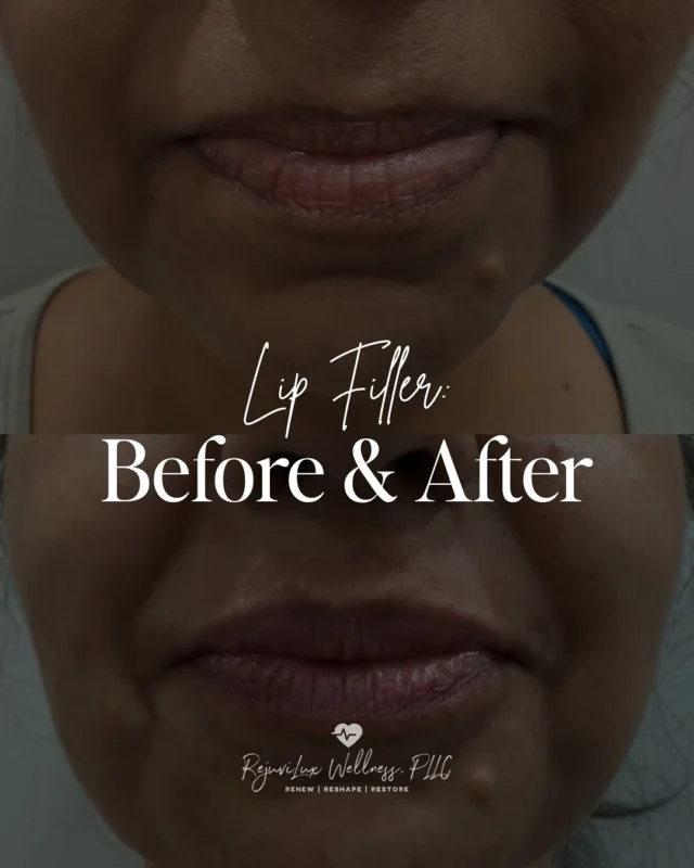 Home 9 - RejuviLux Wellness, PLLC ✨ Just 1ml. That’s it.
Soft, subtle, and still so you 💋
This beauty came in wanting a little more balance + definition to her lips without feeling overdone — and we did exactly that using 1ml of Restylane Kysse.
Notice how her natural shape is still there? That’s the goal 🙌🏽
A soft plump. Smoothing out fine lines. Adding just enough volume to make gloss hit different.
The best part? Results like this are completely customizable. Whether it’s your first time or you’re coming in for a refresh, I’ll walk you through everything and make sure your lips still feel like you — just with a little ✨extra✨
DM me “LIPS” if you’ve been thinking about it but aren’t sure where to start — or tap the link in bio to book your consult 💻💉
— RejuviLux Wellness
Renew | Reshape | Restore
#sanantoniomedspa #lipfiller #npinjector #sanantoniowomen #sanantoniomom #aestheticnurse #aestheticnursepractitioner